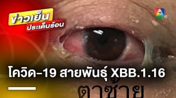 เปิดภาพ ! ชายไทยติดโควิด-19 สายพันธุ์ XBB.1.16 มีอาการ ตาแดง-ขี้ตาเหนียว